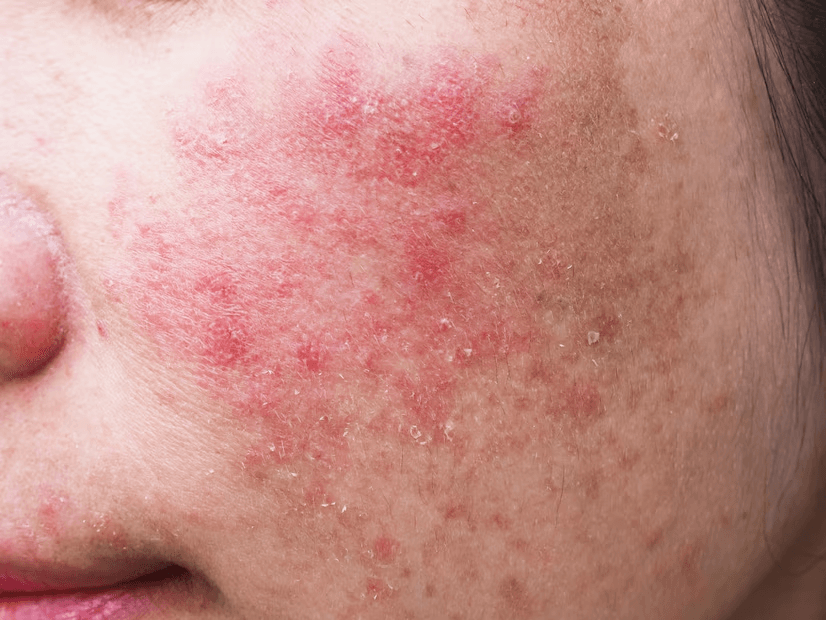 Acne image 2