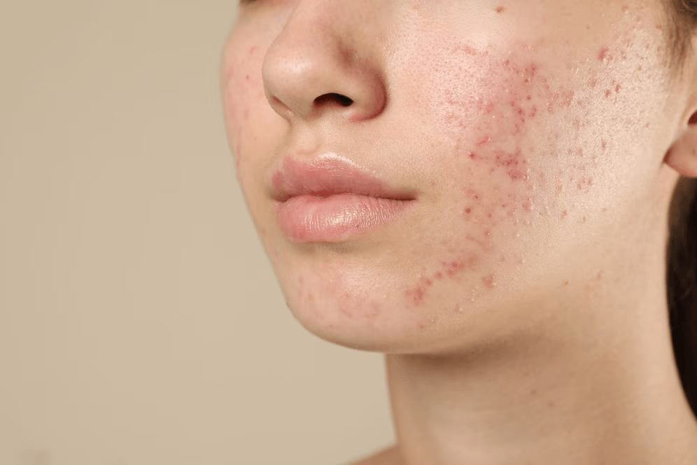 Acne main image