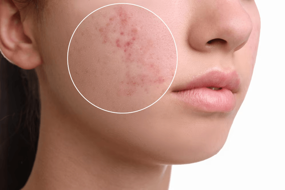 Acne image 3