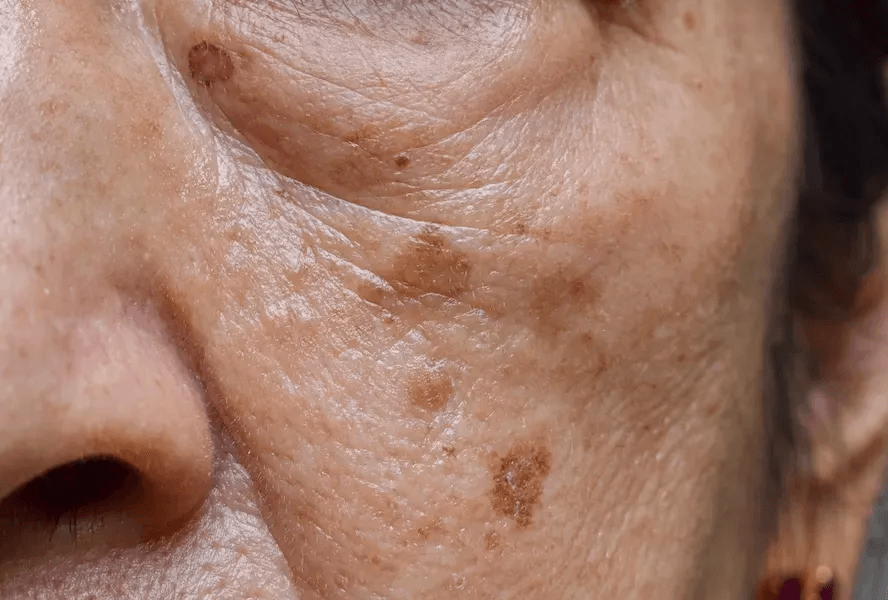 Actinic Keratosis image 2