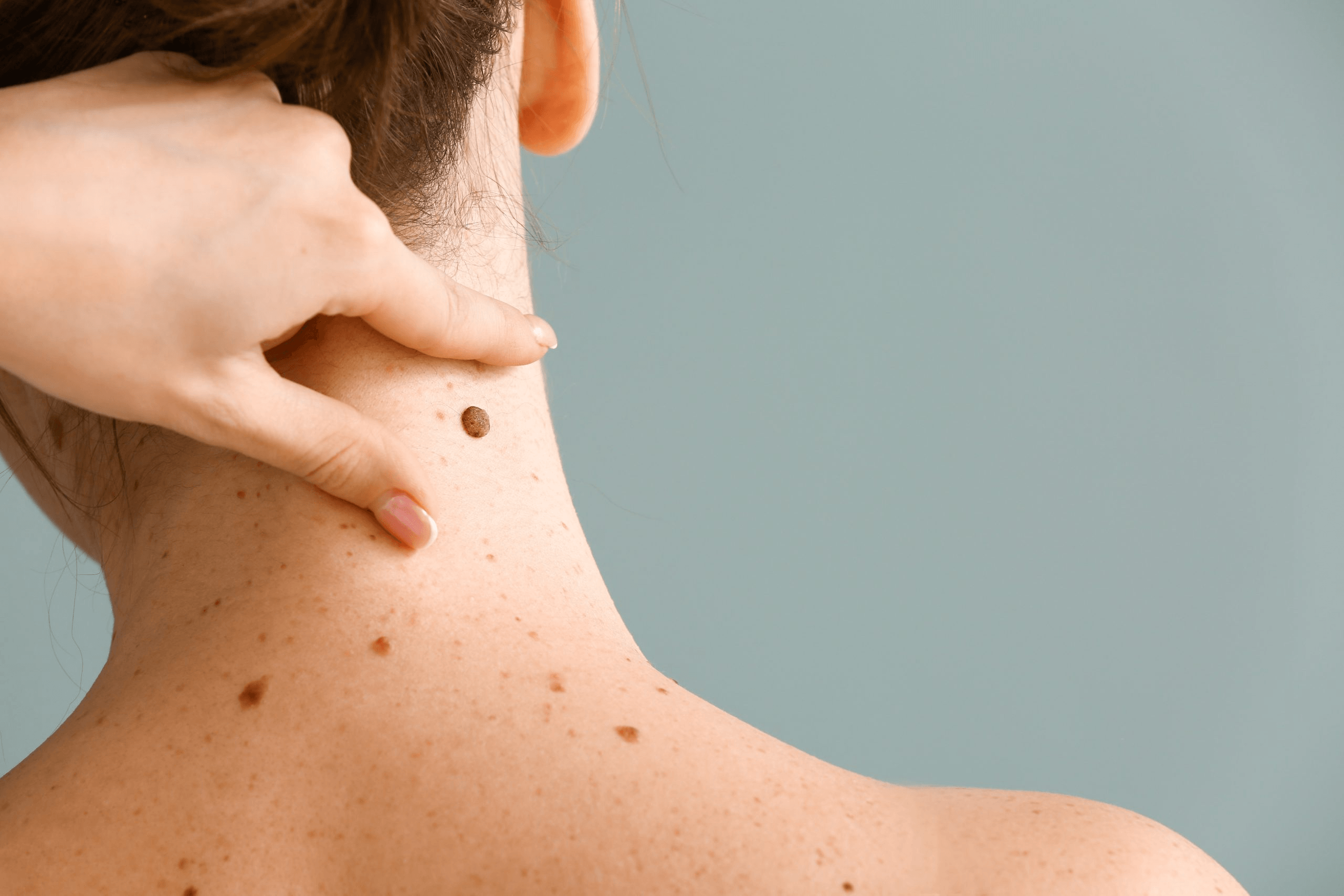 Actinic Keratosis image 3