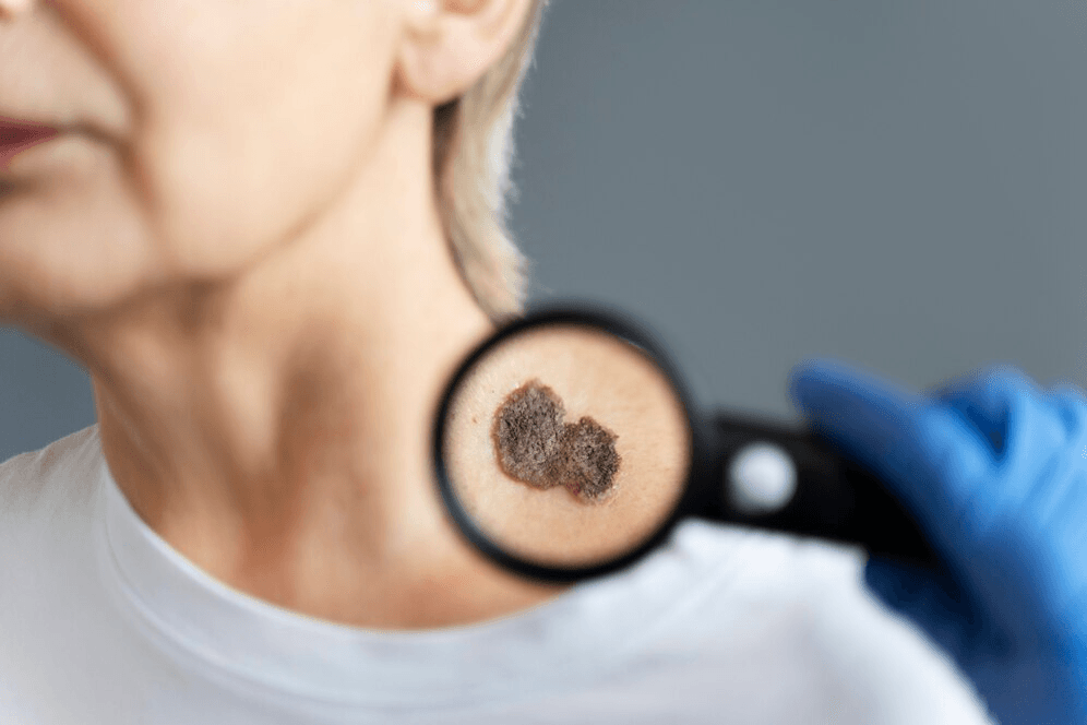 Actinic Keratosis main image