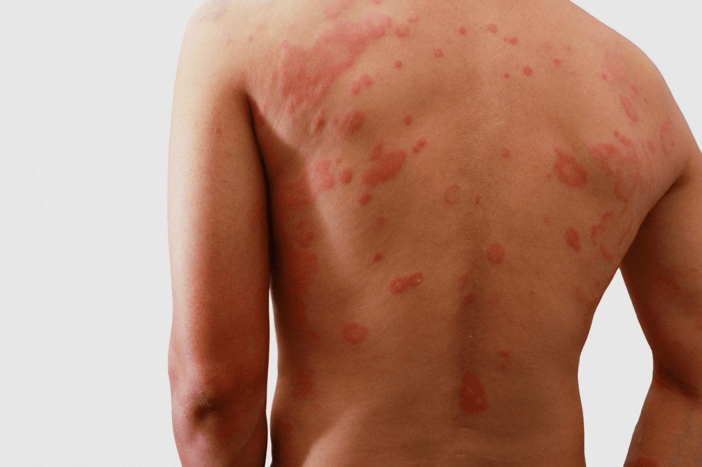 Dermatitis  image 2
