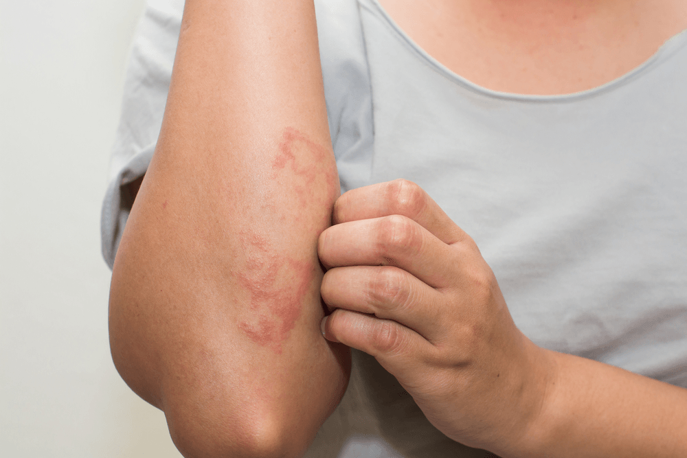 Dermatitis  image 3