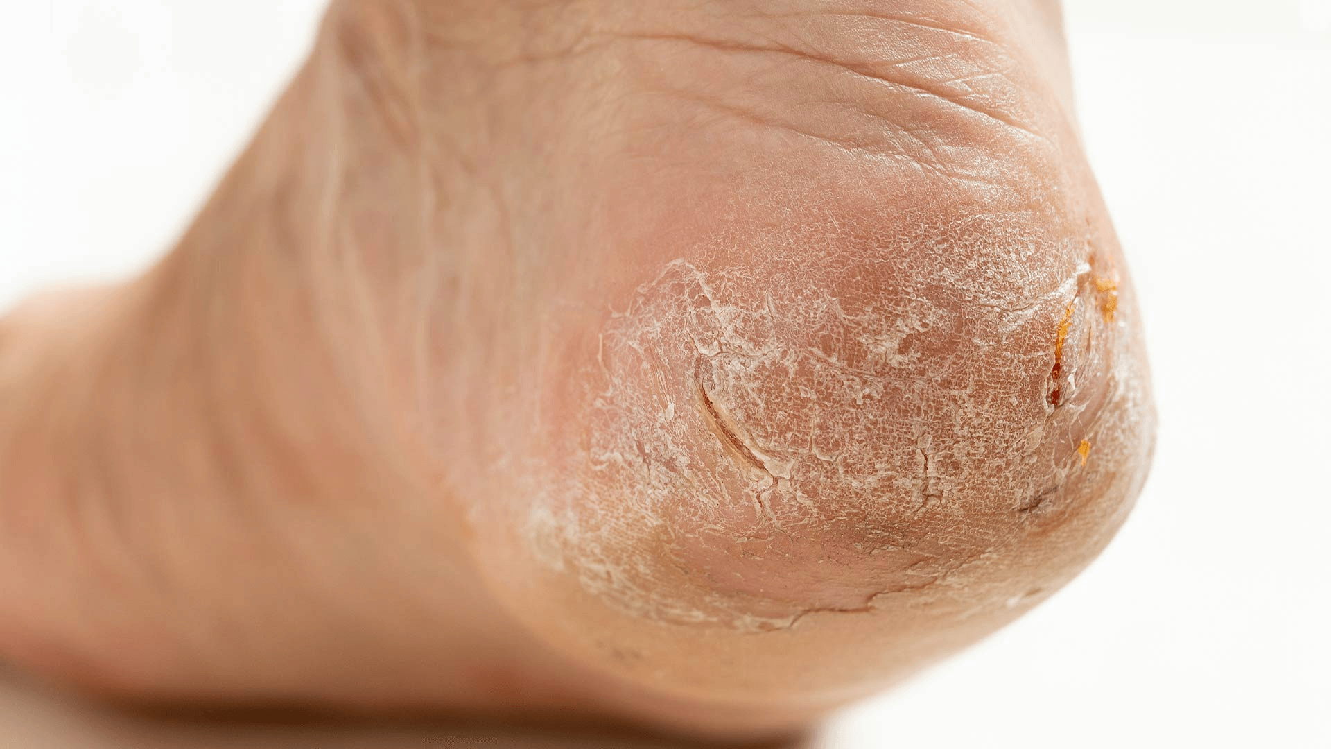 Dry, Cracking Skin image 3
