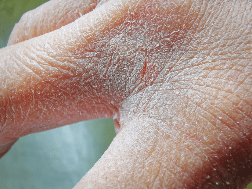 Dry, Cracking Skin main image