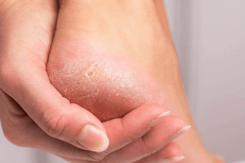 Dry, Cracking Skin image 2