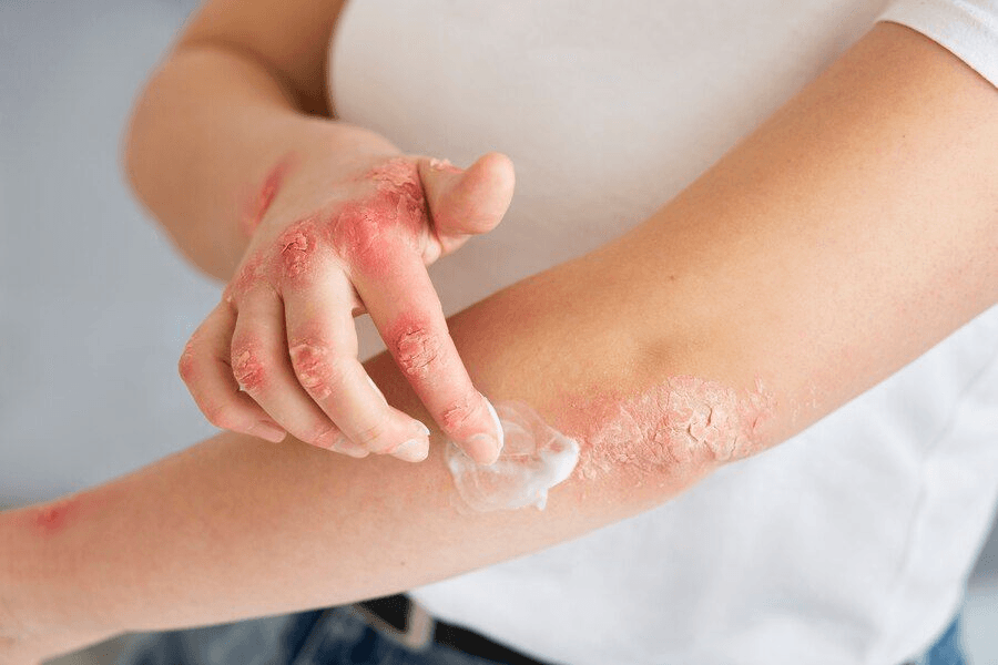Eczema / Psoriasis image 2
