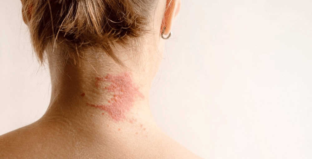 Eczema / Psoriasis image 3