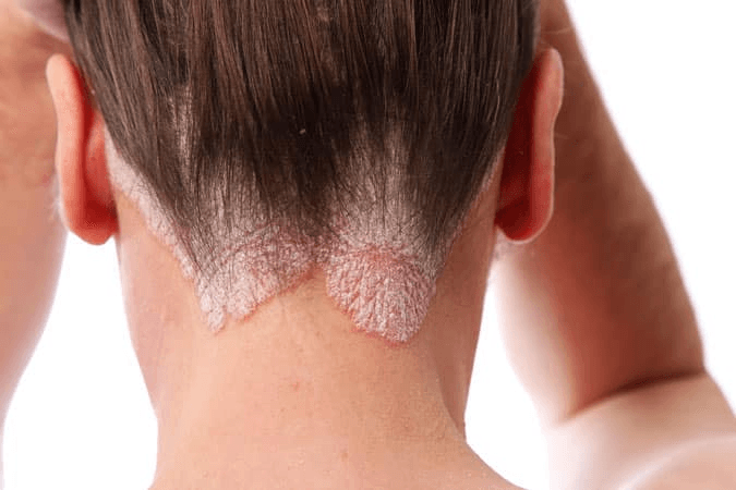 Eczema / Psoriasis with Corticosteroids image 3