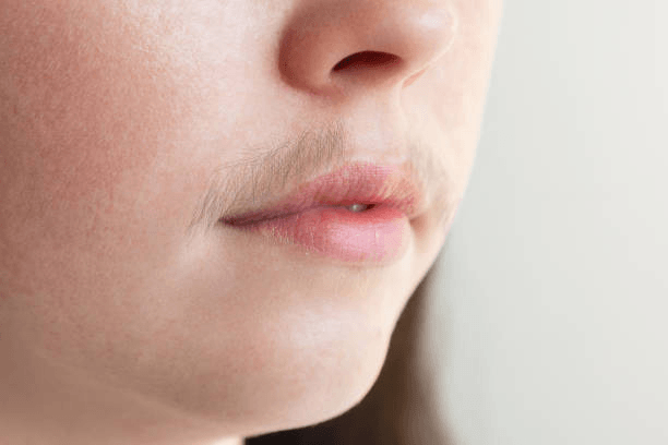 Hirsutism image 3