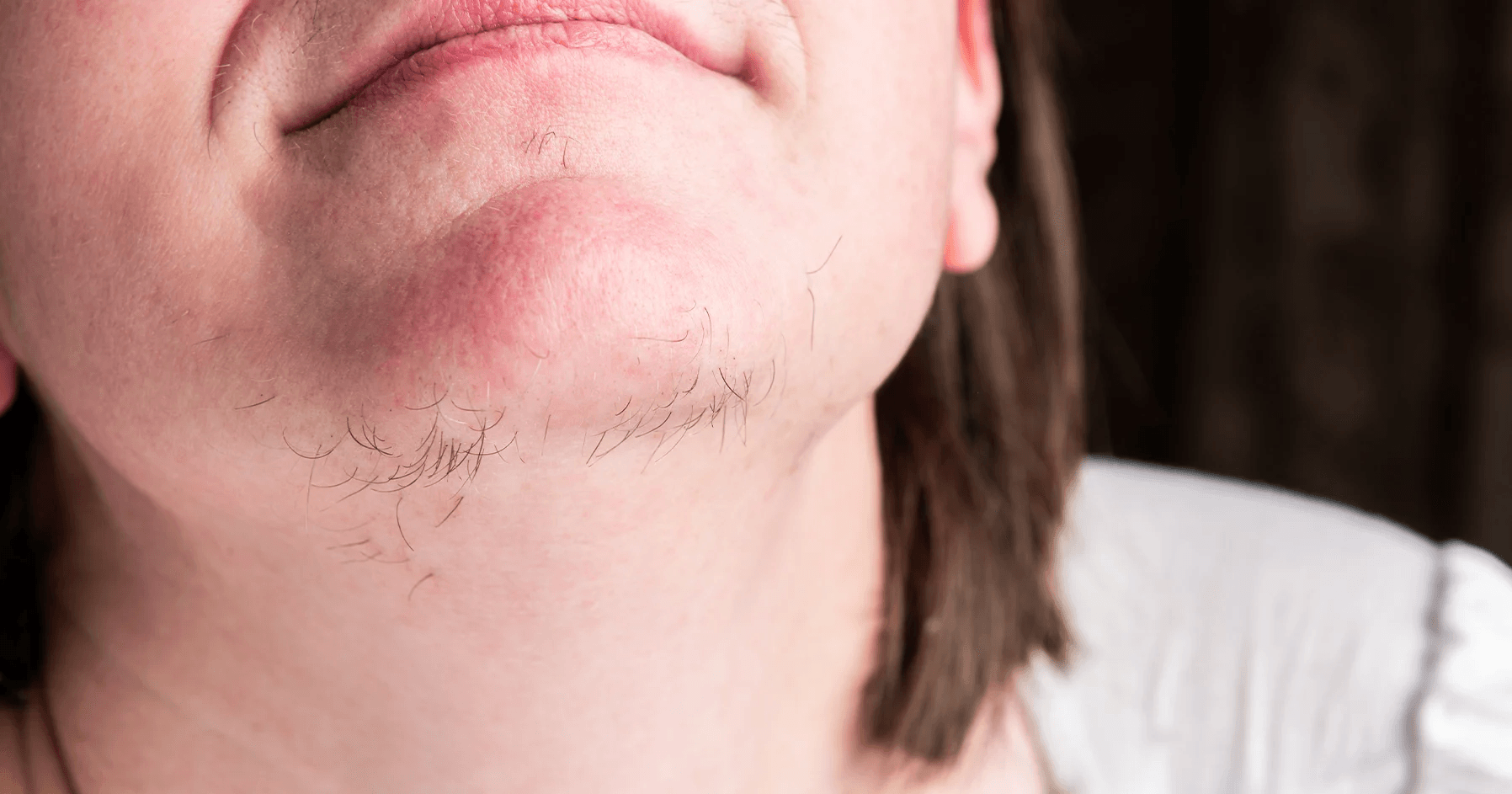 Hirsutism image 2