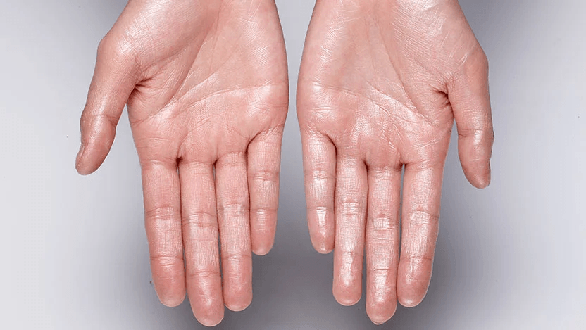 Hyperhidrosis image 2