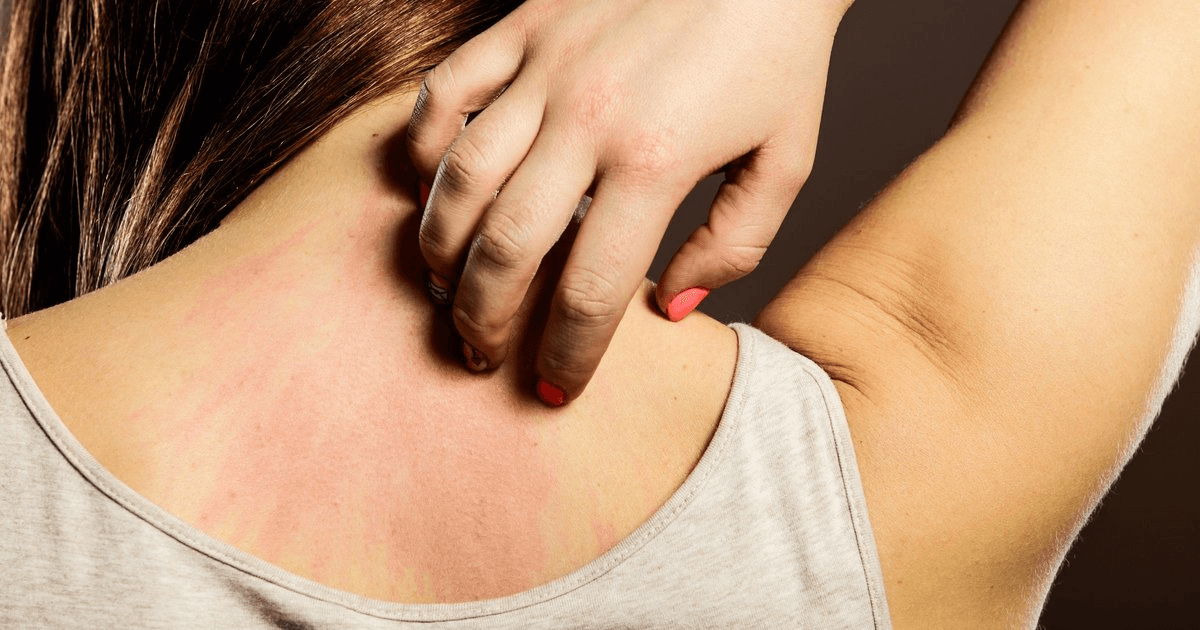 Itching (Pruritus) image 3