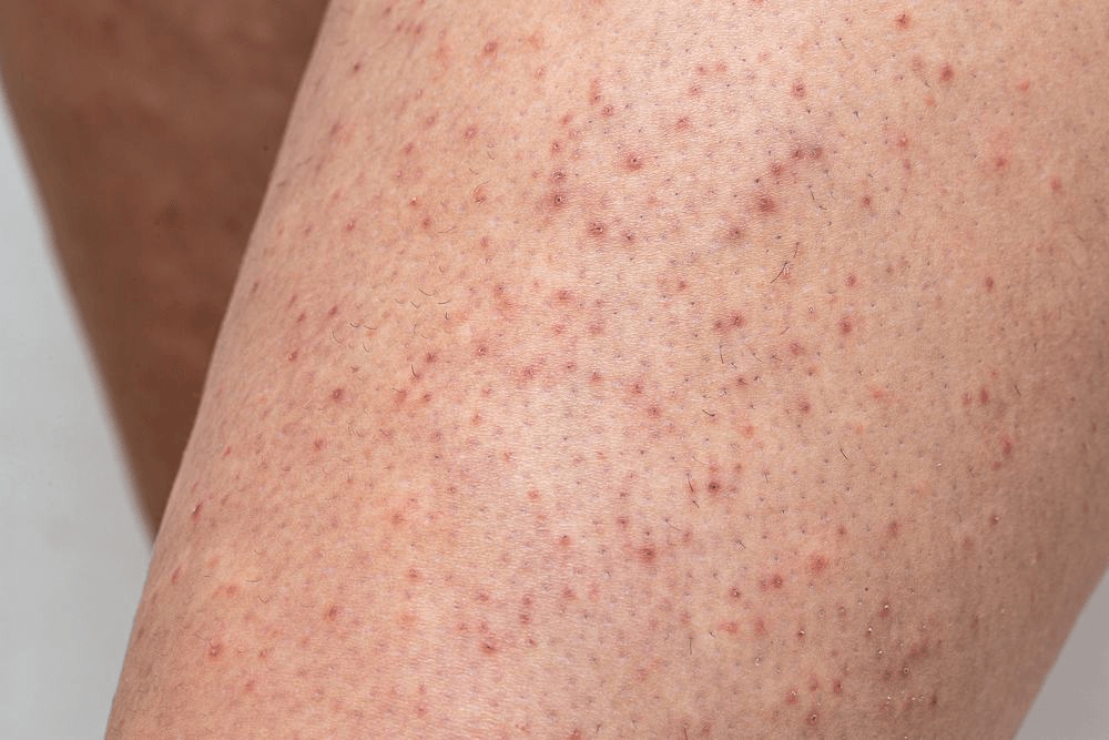 Keratosis Pilaris image 2