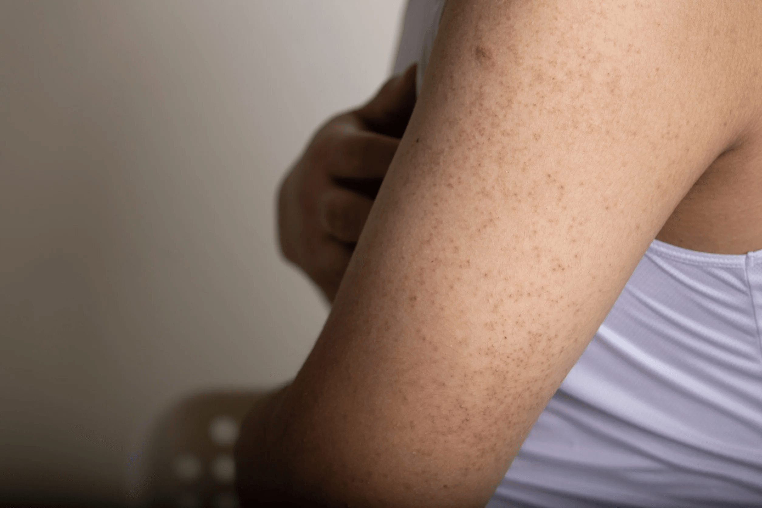 Keratosis Pilaris main image