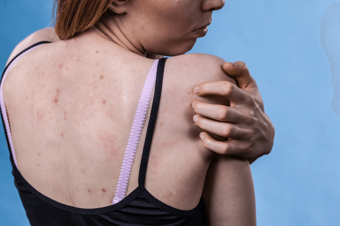 Keratosis Pilaris image 3