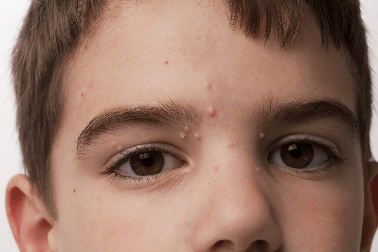 Molluscum Contagiosum image 2