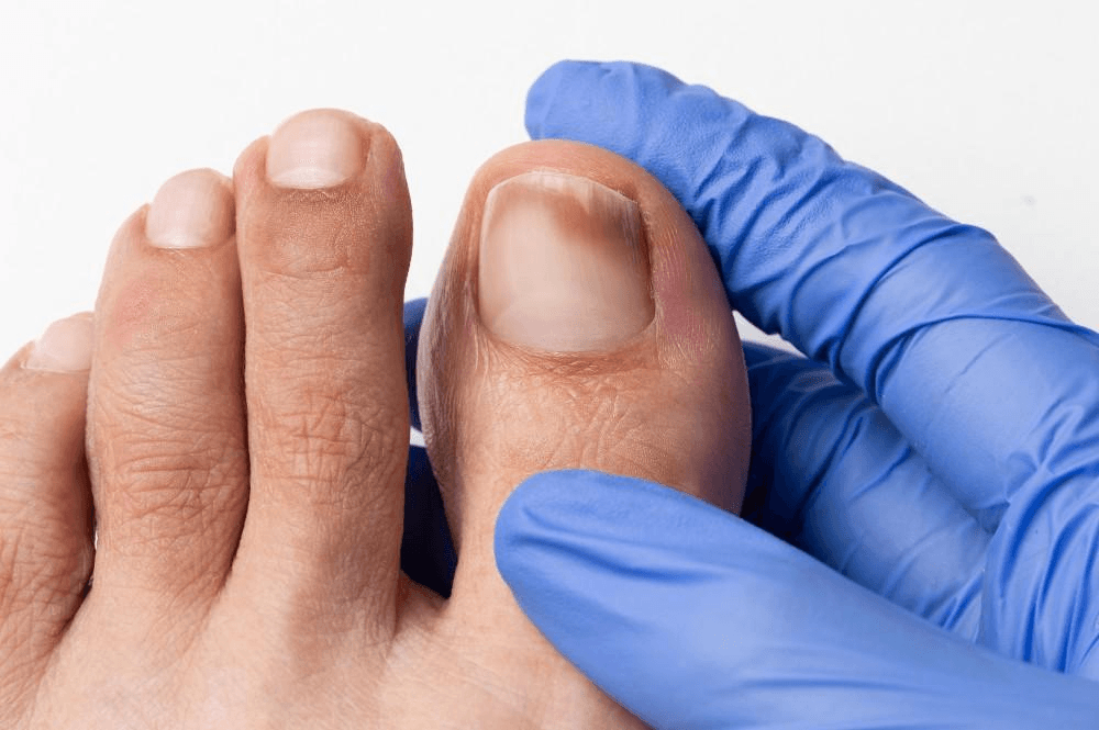 Nail Fungus main image