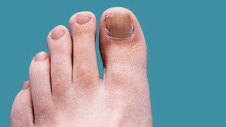 Nail Fungus image 3