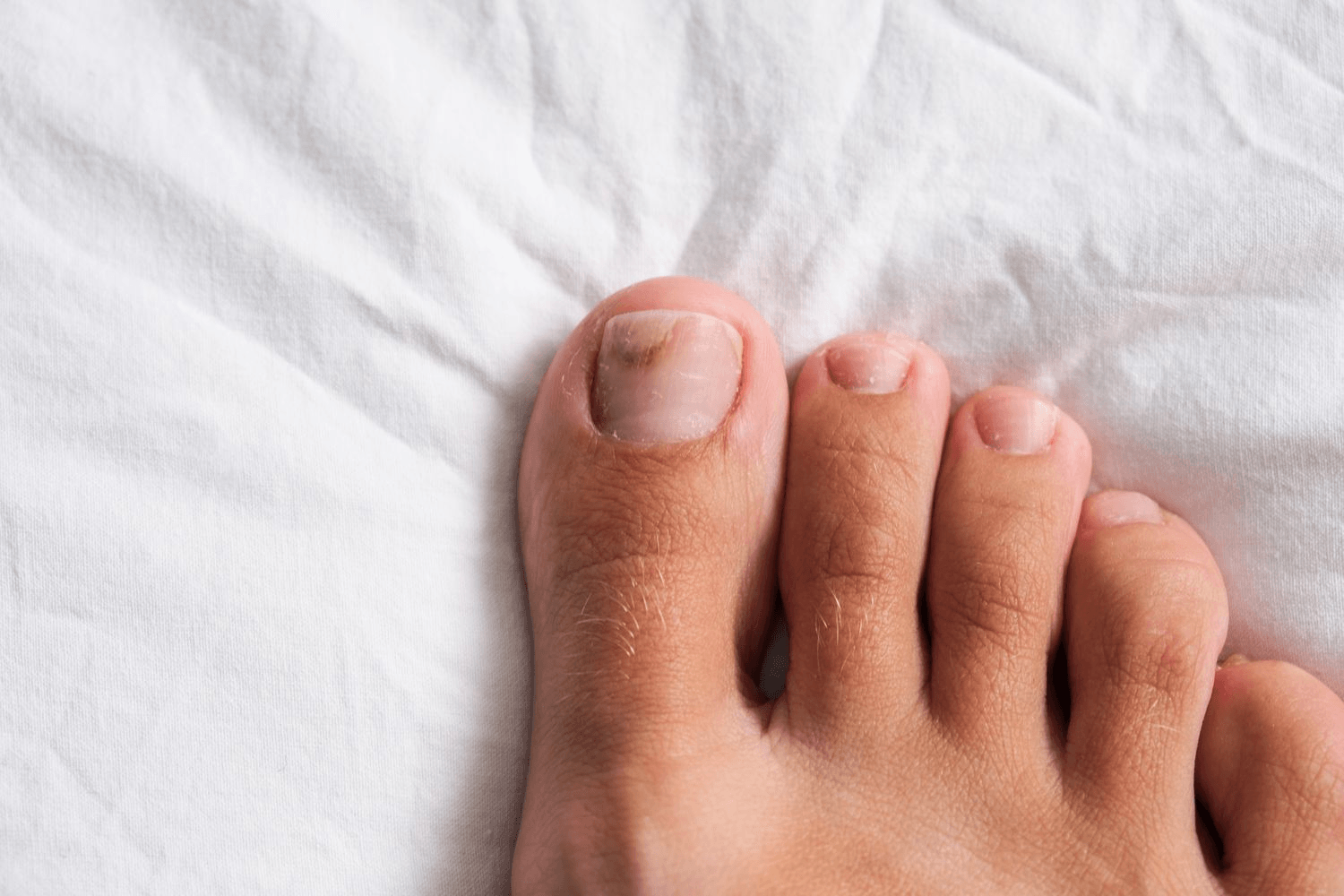Nail Fungus image 2