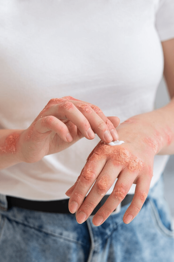 Eczema / Psoriasis with Corticosteroids main image