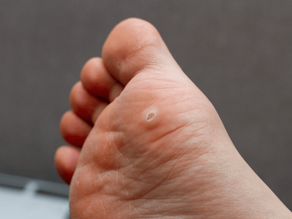 Porokeratosis main image