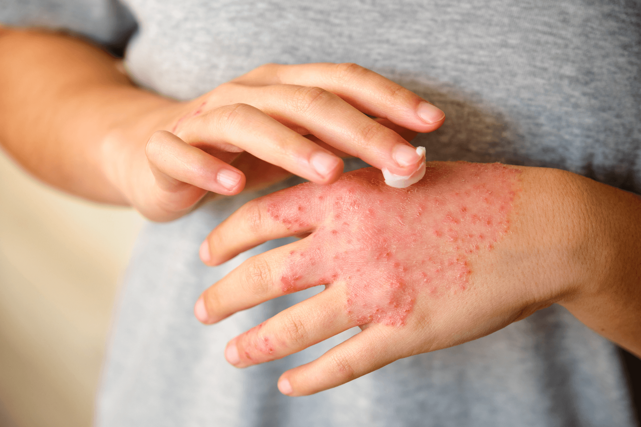 Dermatitis  main image