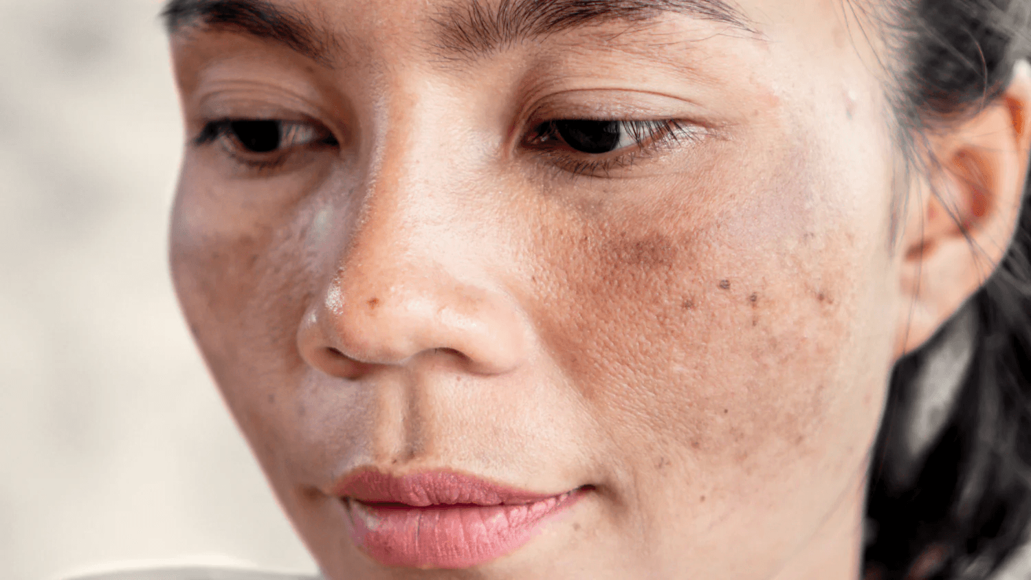 Skin Bleaching image 3