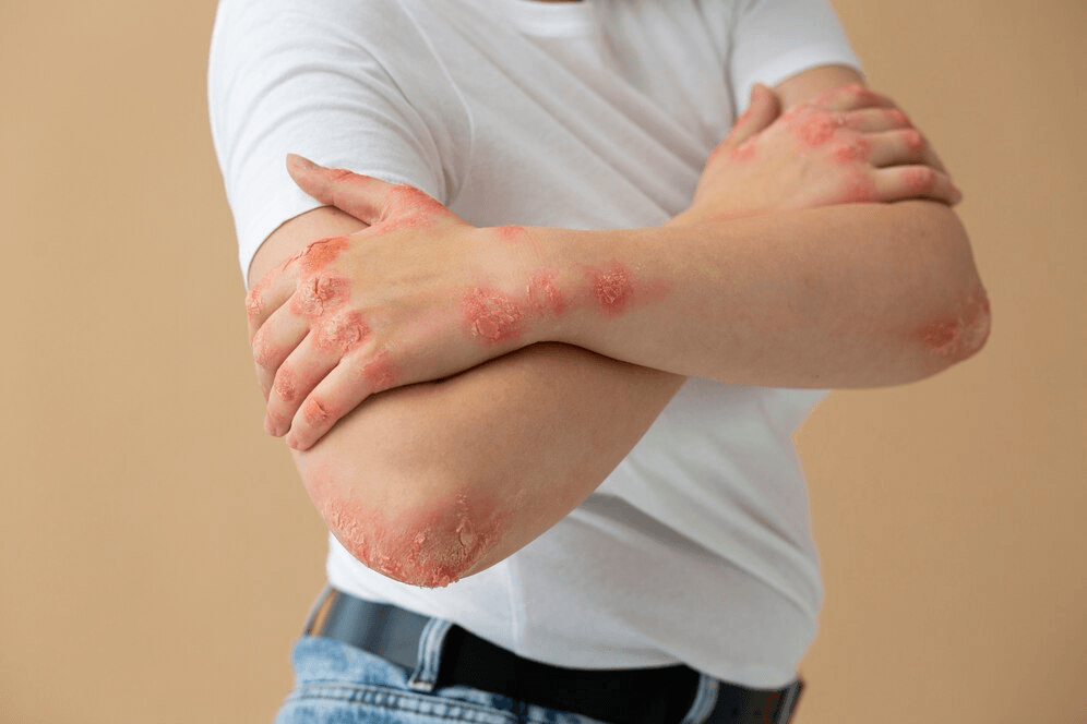 Eczema / Psoriasis main image