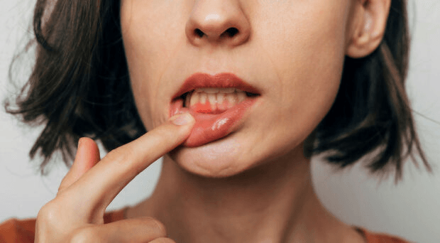 Oral Mucositis main image