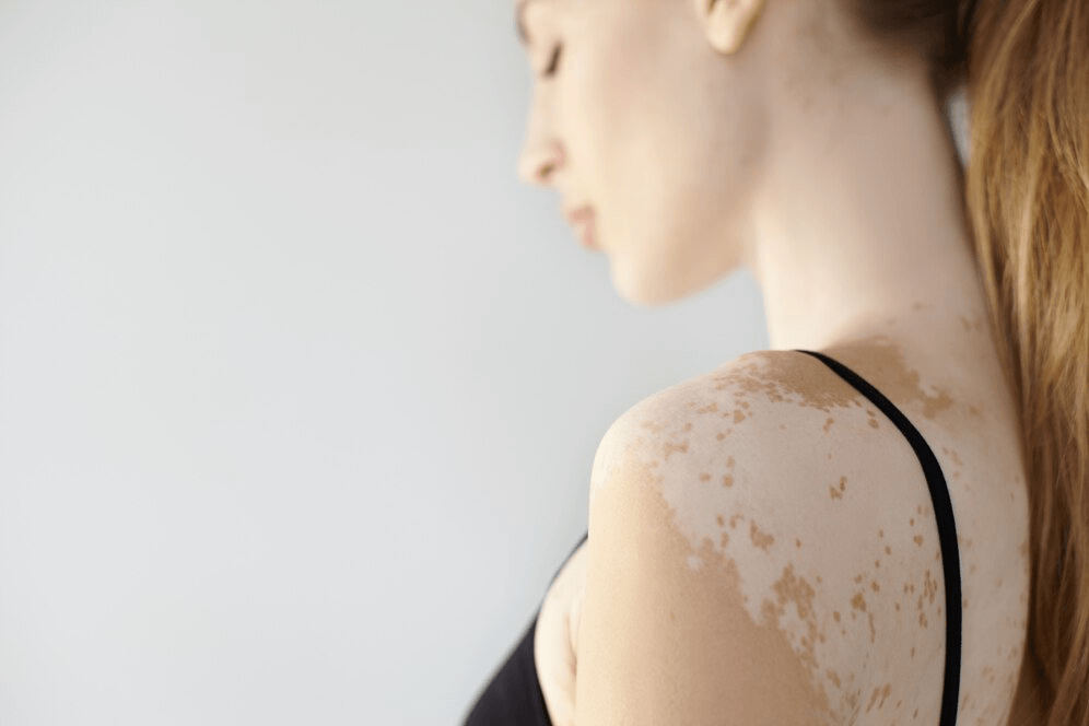 Skin Bleaching main image