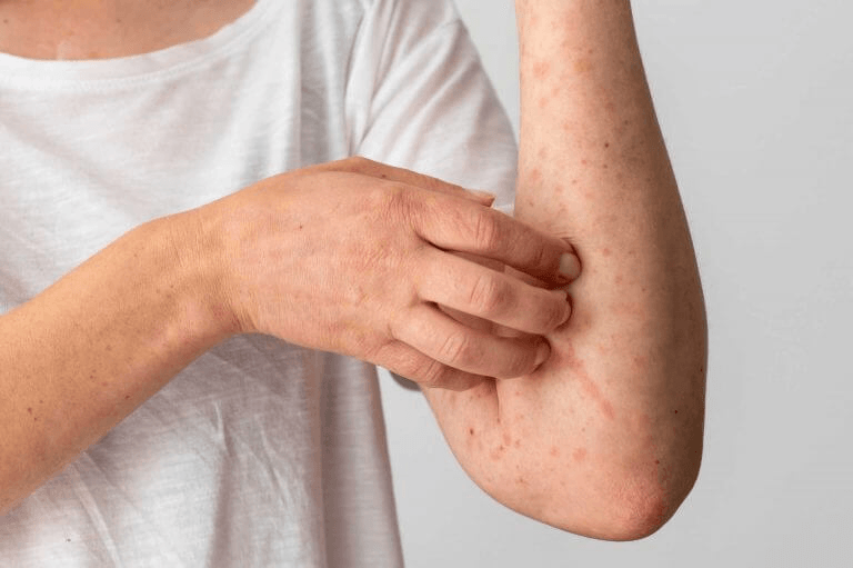Itching (Pruritus) main image
