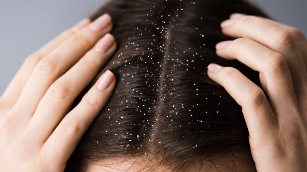 Dandruff main image