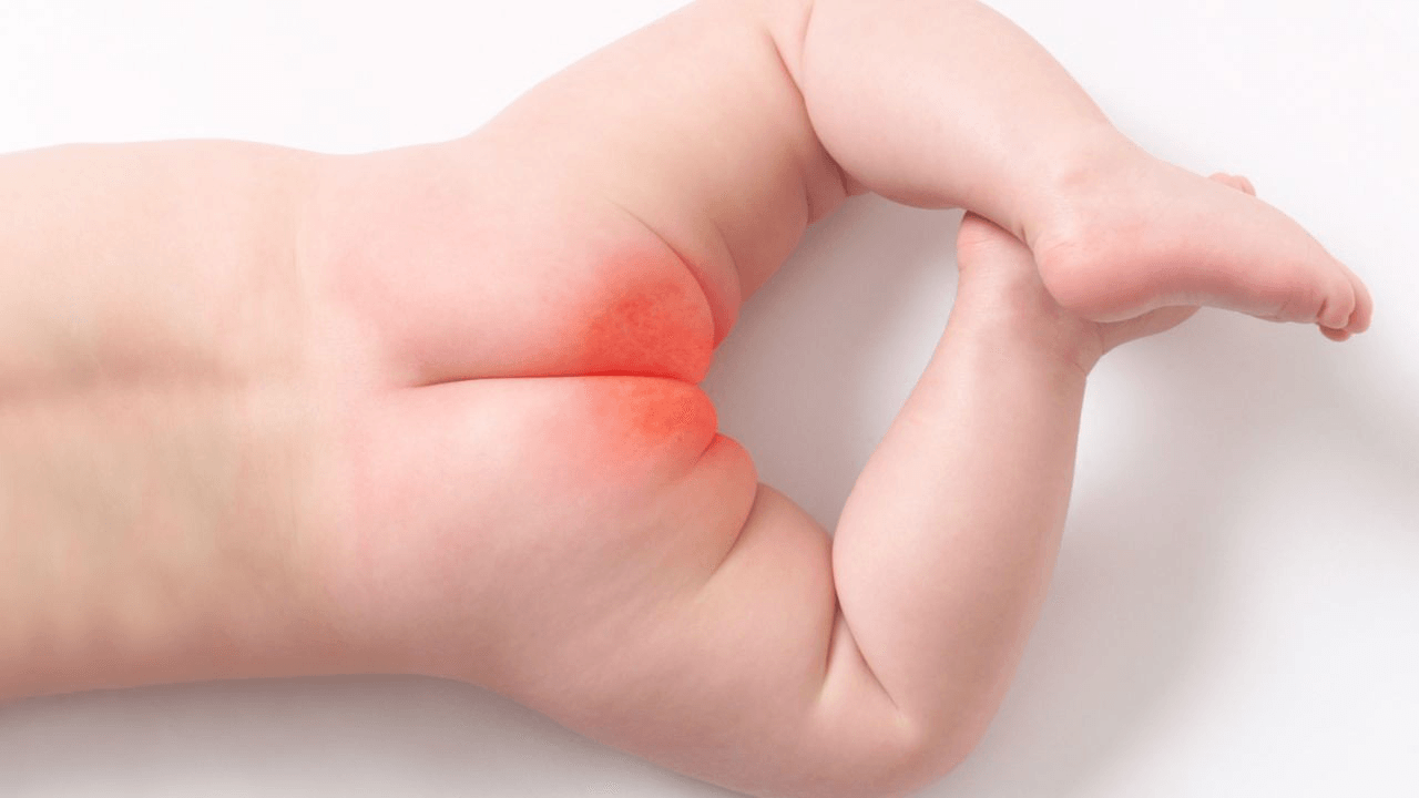 Diaper Rash main image