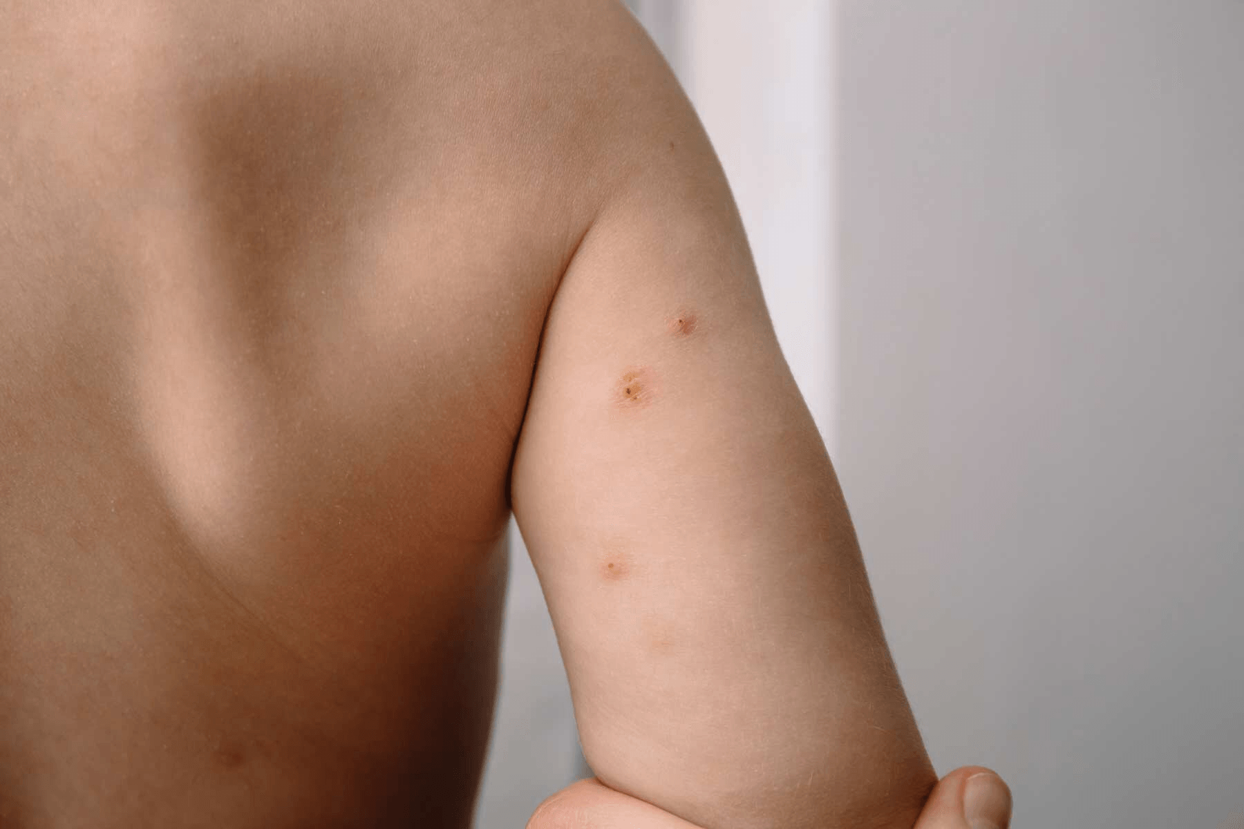 Molluscum Contagiosum main image