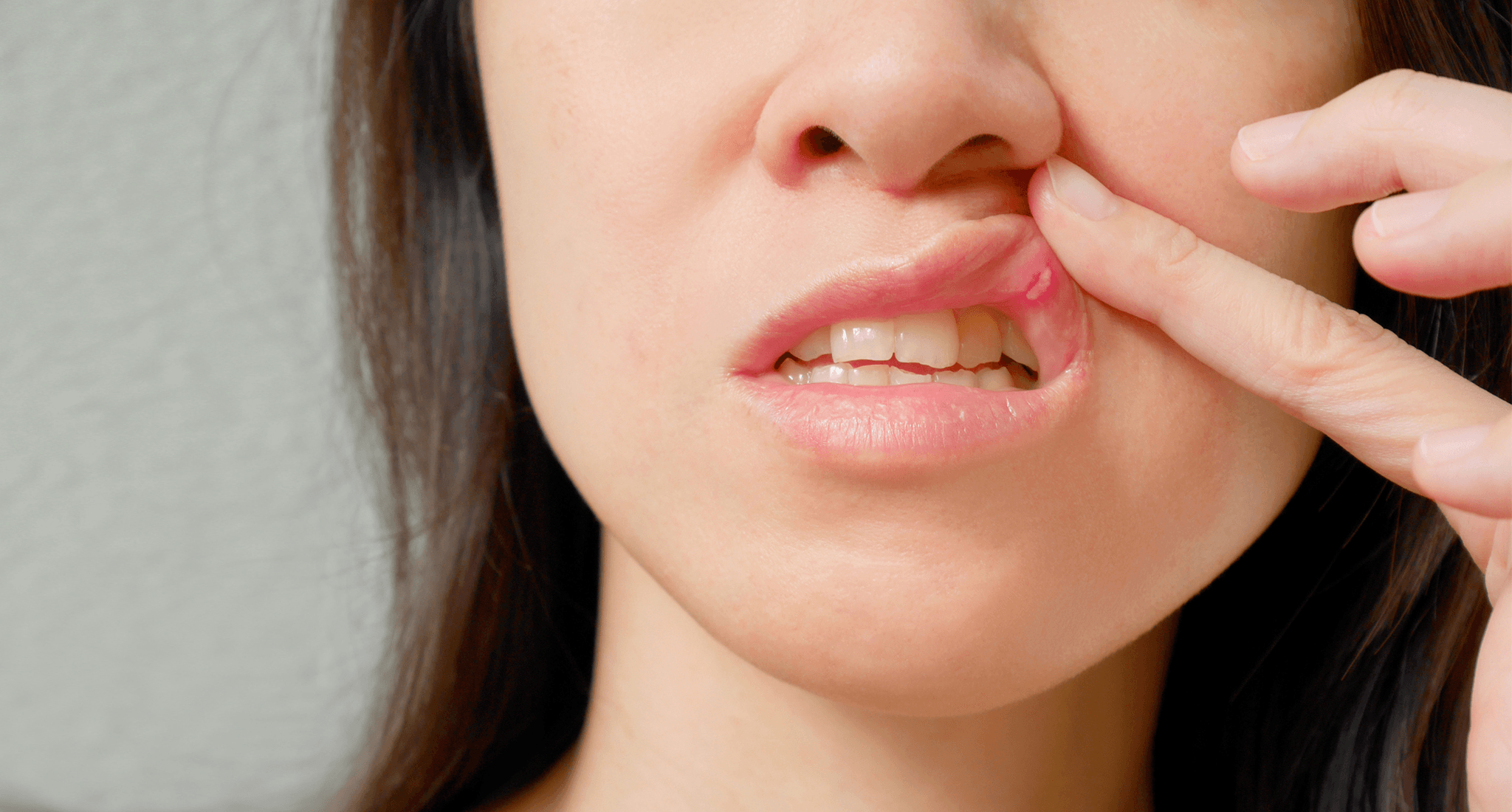 Oral Mucositis image 2