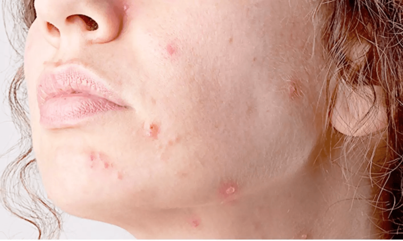 Porokeratosis image 3