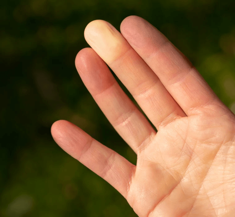 Raynaud’s main image