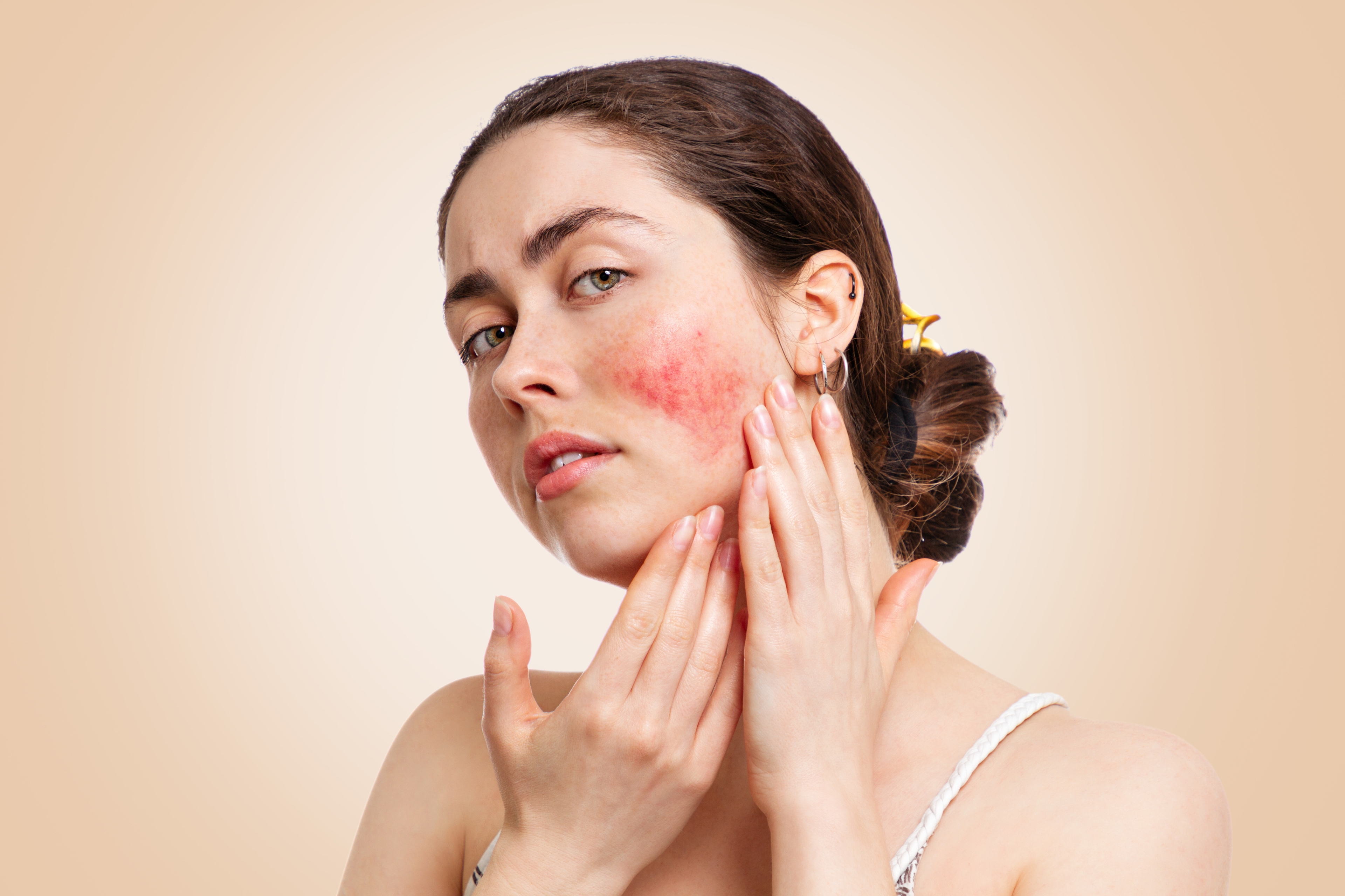 Rosacea main image