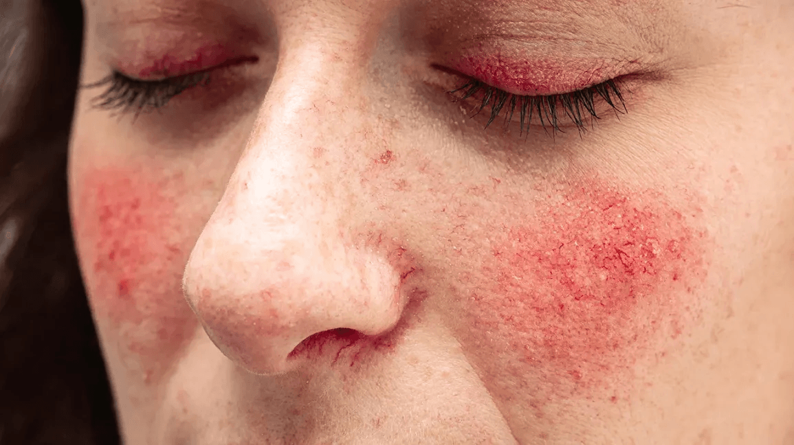 Rosacea image 2