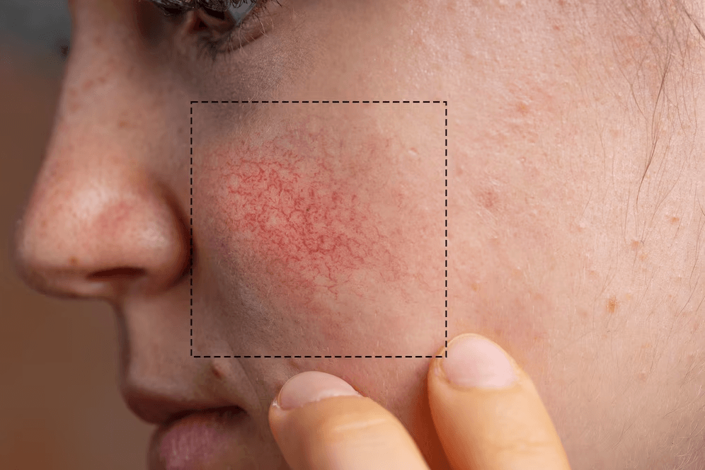 Rosacea image 3