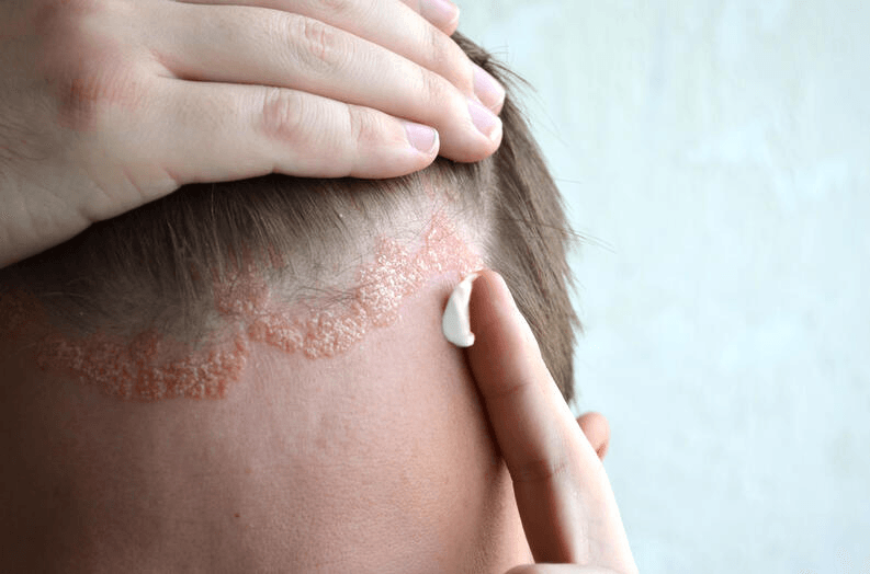 Seborrheic Dermatitis main image