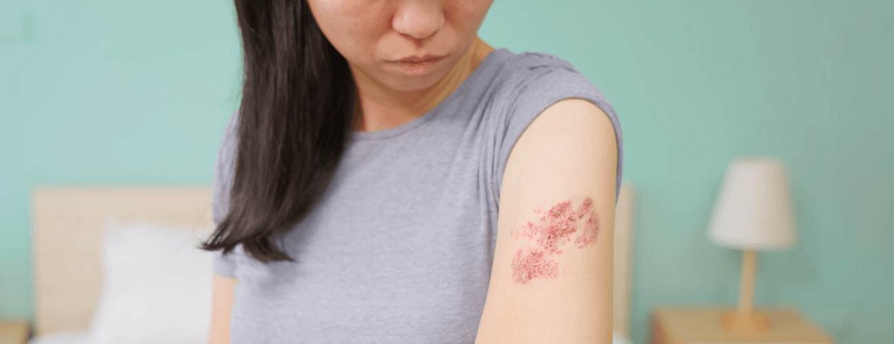 Shingles image 3