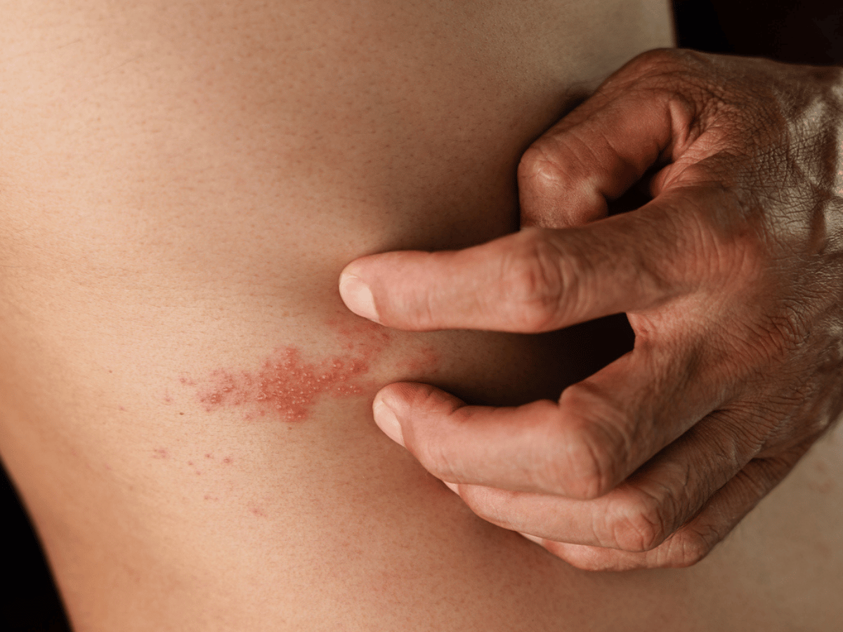 Shingles image 2