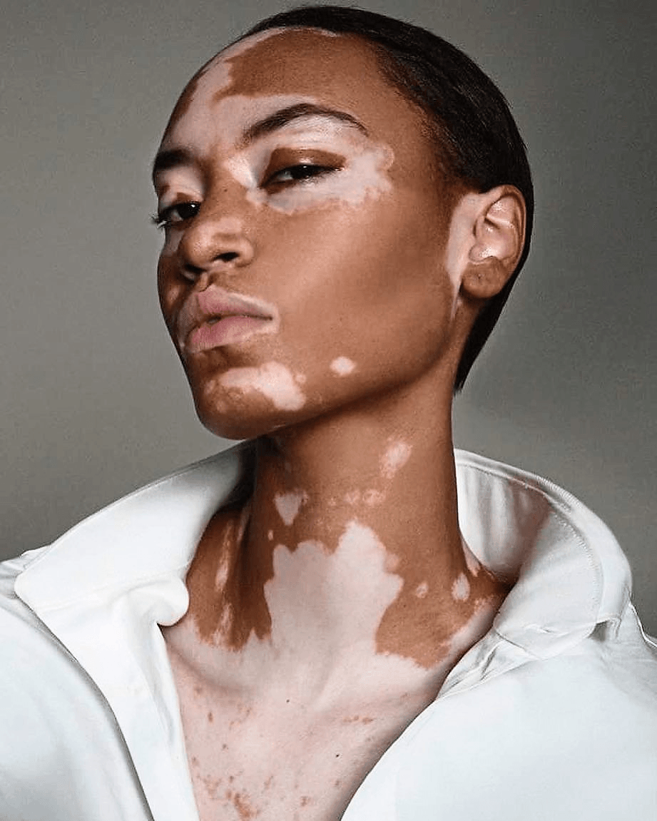 Vitiligo image 3