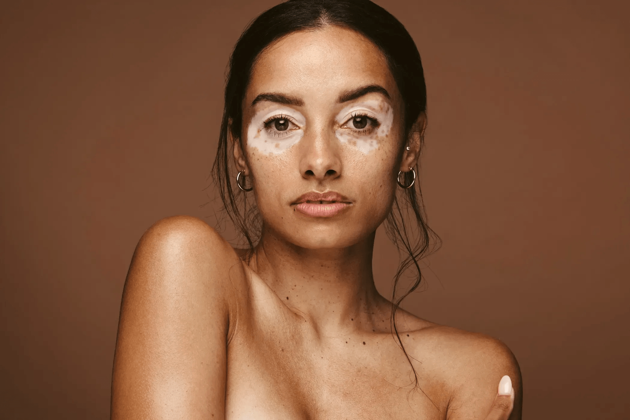 Vitiligo main image