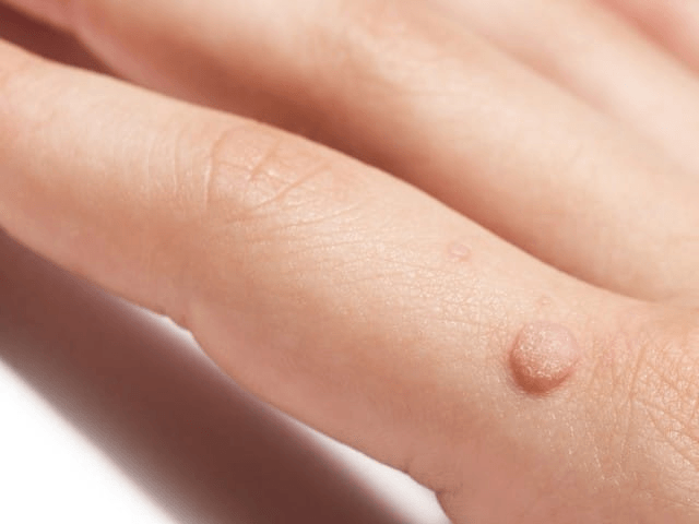 Warts image 2