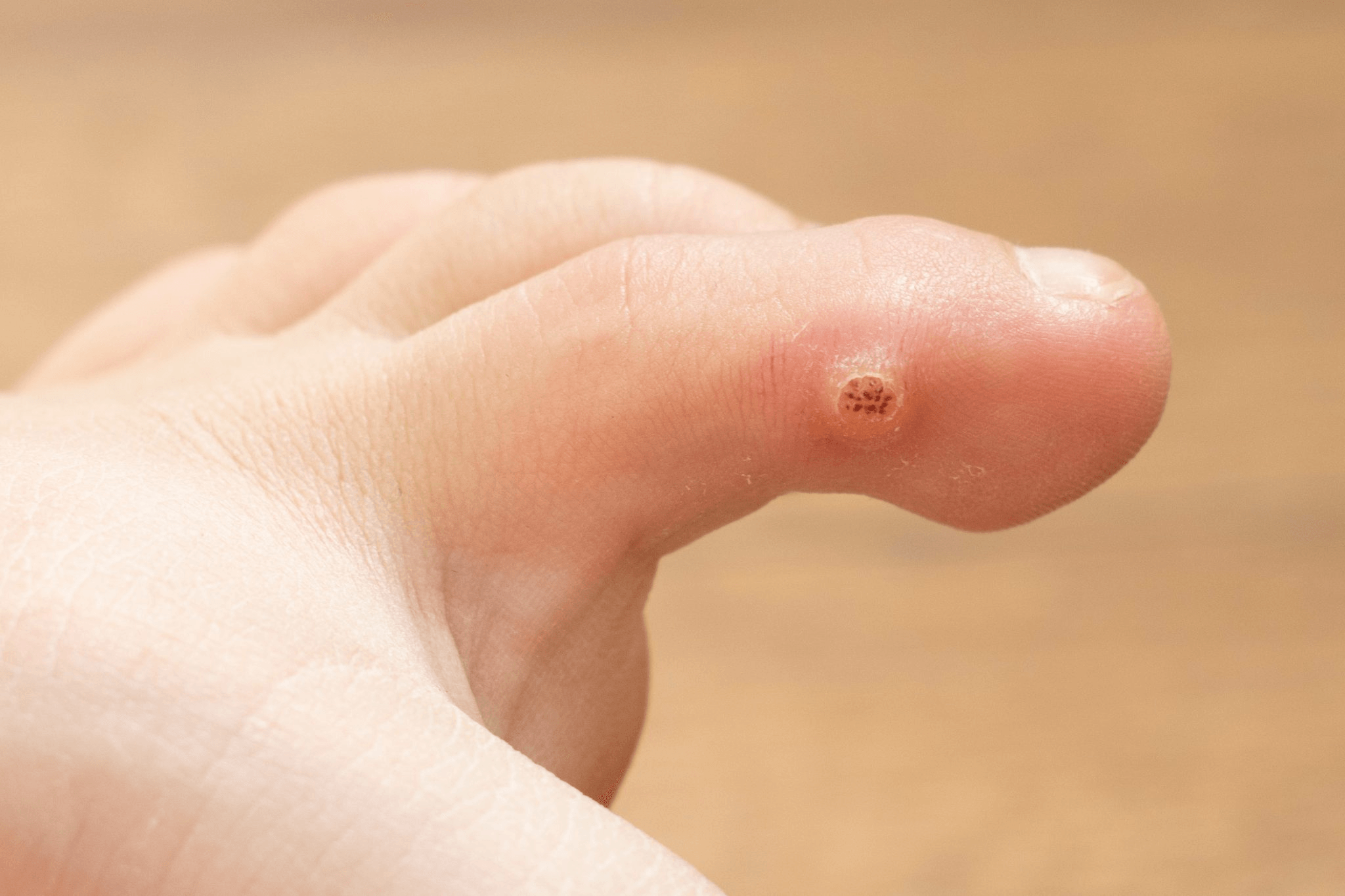 Warts image 3