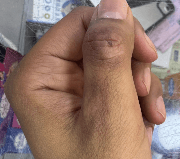 after treatment